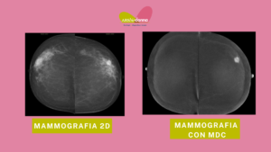 mammografia con mezzo di contrasto