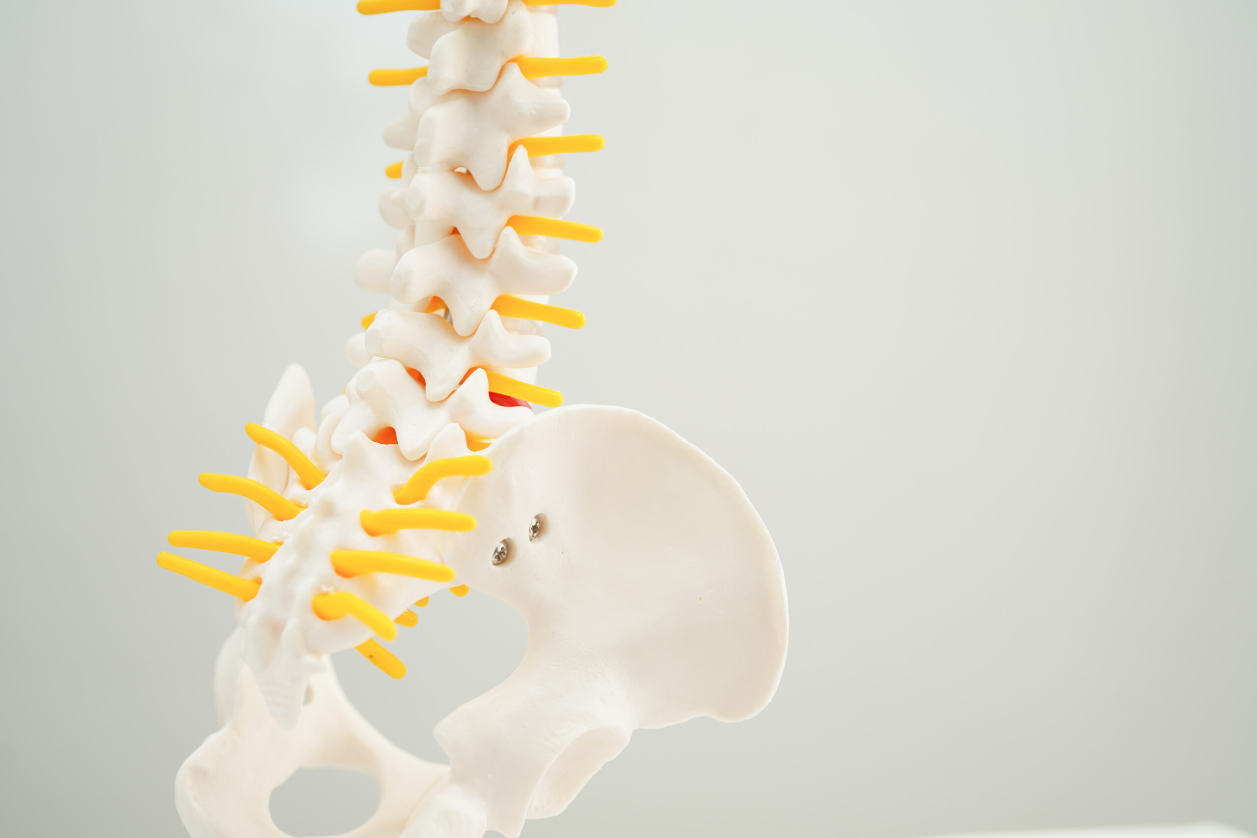 SPINOMED V (ex SPINOMED IV) - Busto ortopedico per crolli vertebrali