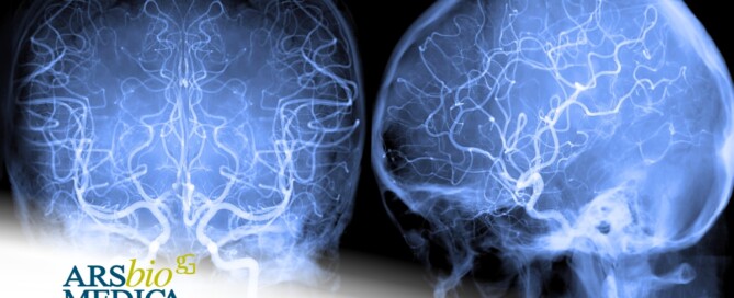 aneurisma cerebrale prevenzione