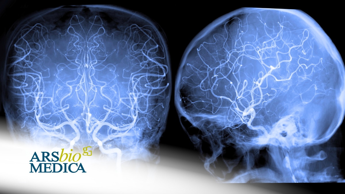 aneurisma celebrale prevenzione